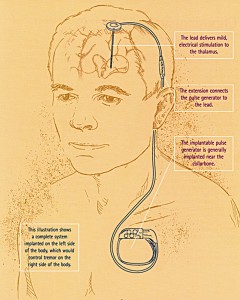 An illustration demonstrating a DBS system implanted on the left side to control tremors on the right side of the body. — Courtesy Christopher Duma